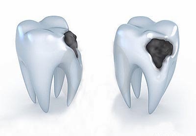 3D diş karies resmi