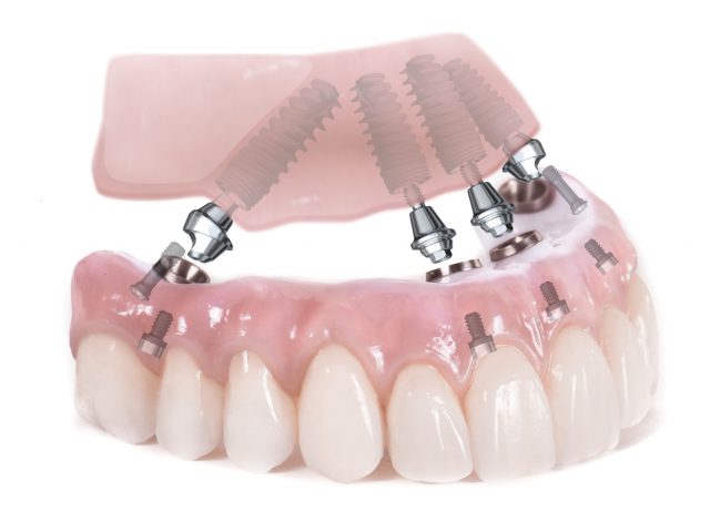 3D üst çene implantlar resmi