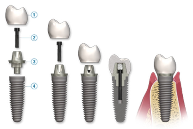 Diş implantları-yapısı