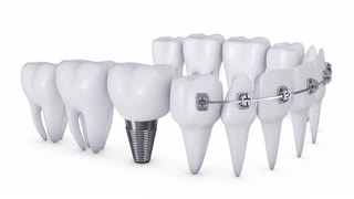 3D diş implat resmi