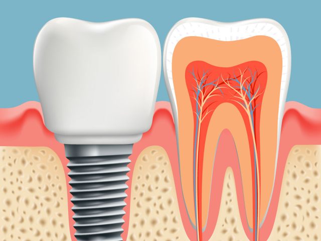 Diş implant diagramı