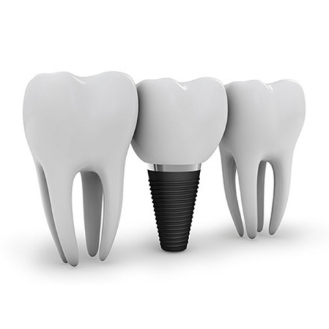 dental-implants-lehigh-valley