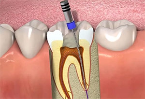 Endodonti