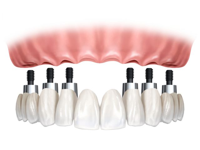 Üst çene implantları