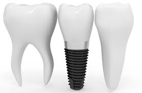 Farklı model implantlar